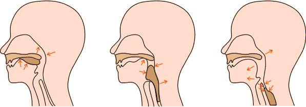 求证吞咽障碍能告别鼻饲管吗