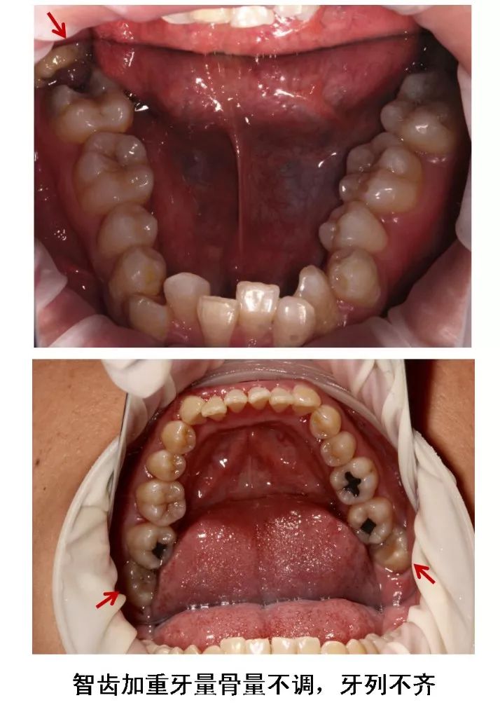 最后面的智齿为何发黑图片