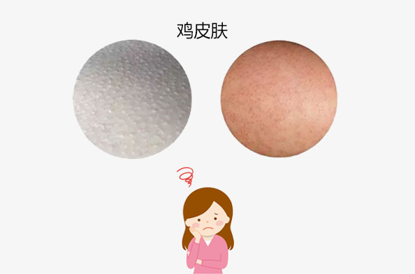 鸡皮肤的女生命运(女生鸡皮肤是什么原因)