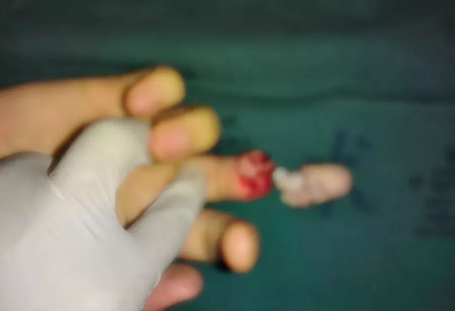 溧阳一男子手指被割断医院竟也能断指再植