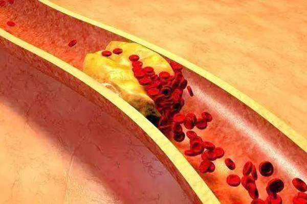 甘油三酯高和哪些原因有关做好两点血脂慢慢降下来