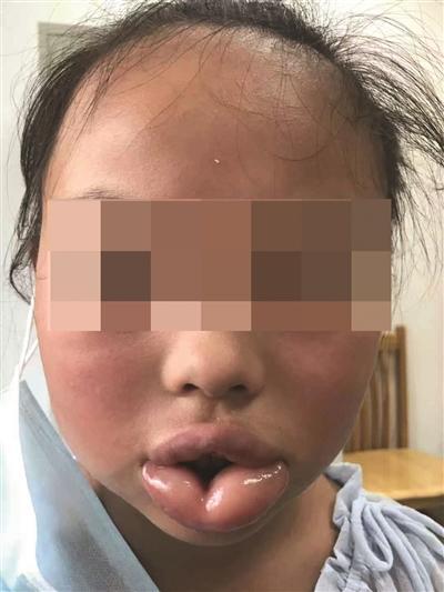 10岁女童咬了一口桃子,嘴唇肿得像香肠