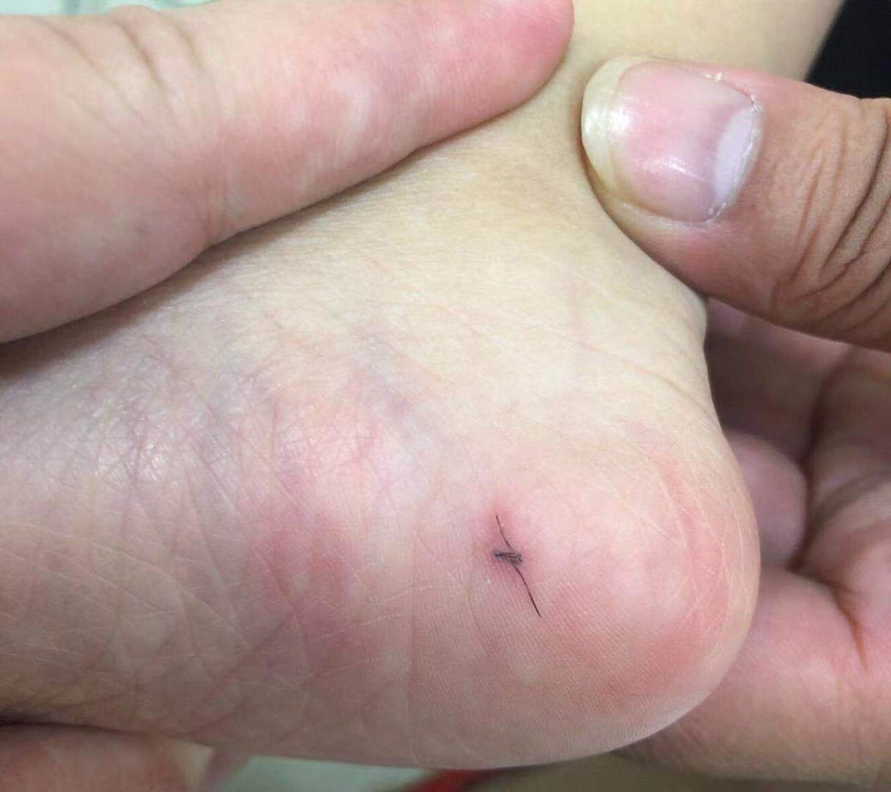 医生一查,竟是根头发!