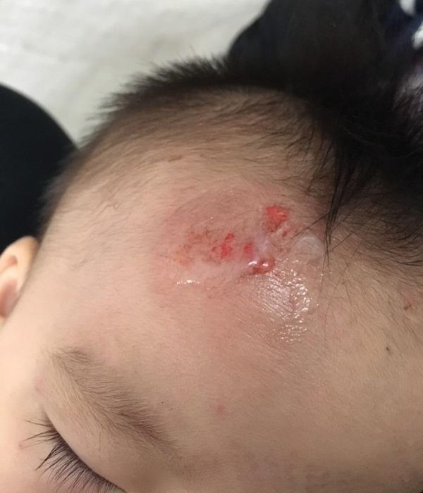 小朋友摔跤受伤的照片图片