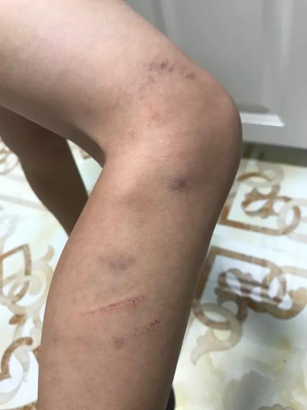 心疼群力一补课班老师脚踹11岁男孩致多处淤青被判