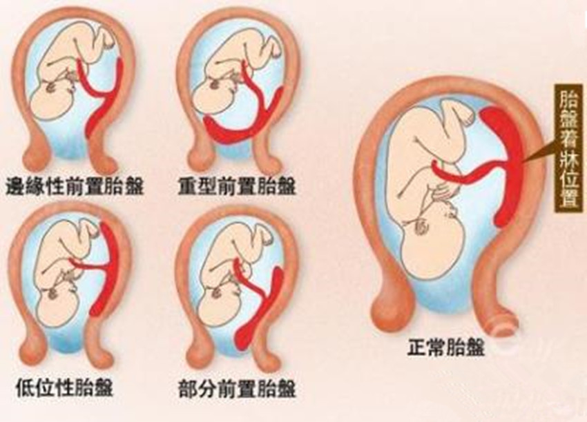 胎儿胎盘图片图片