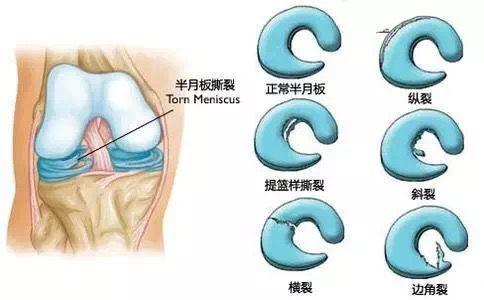 求實瑜伽丨私教必備:膝關節半月板損傷的評估 理療