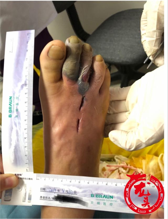 脚上扎了螺丝钉竟浑然不知,糖尿病老人差点失去右脚