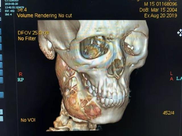 可怕!15岁男孩牙疼一年多,脸部骨头被"吃"掉一半_人民号