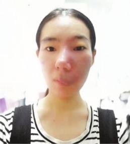 手机中国网@“胎记女孩”成为医生的梦想快要实现了