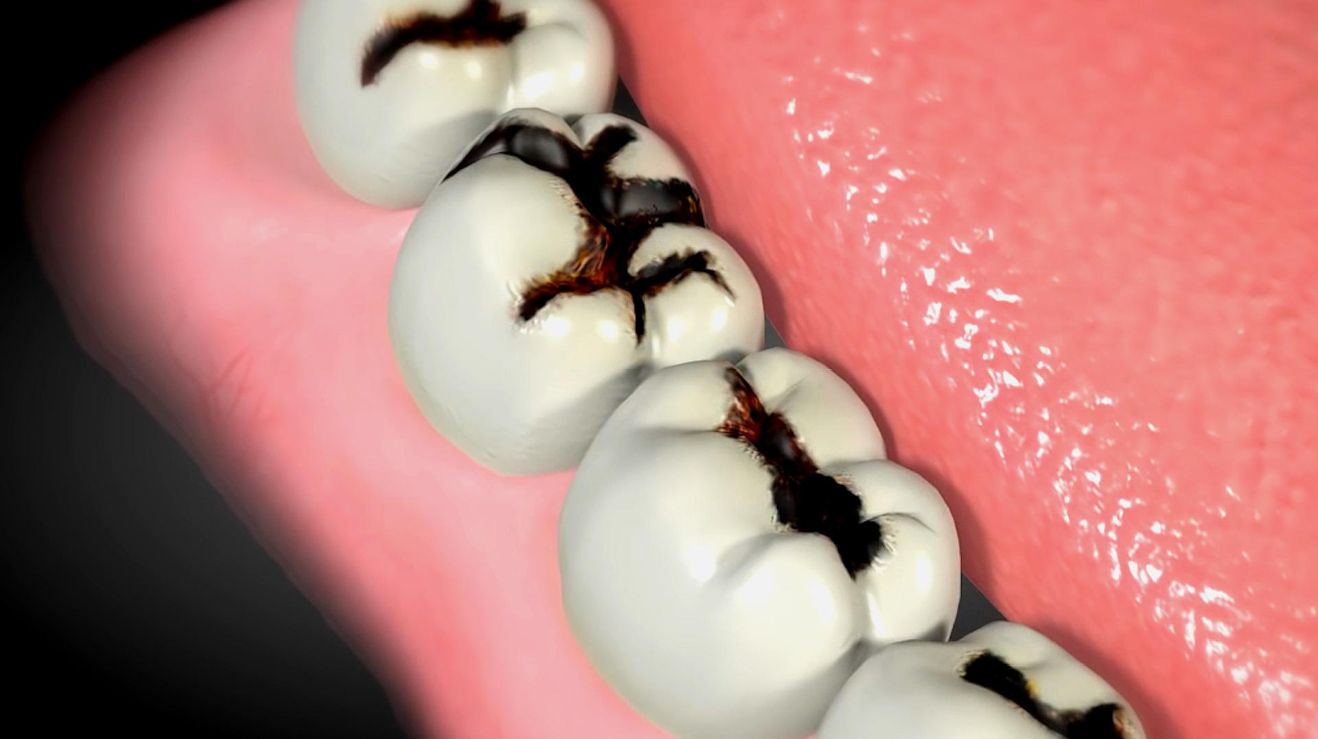73秒带你了解蛀牙的由来牙齿会空并非蚜虫偷吃而是腐蚀造成