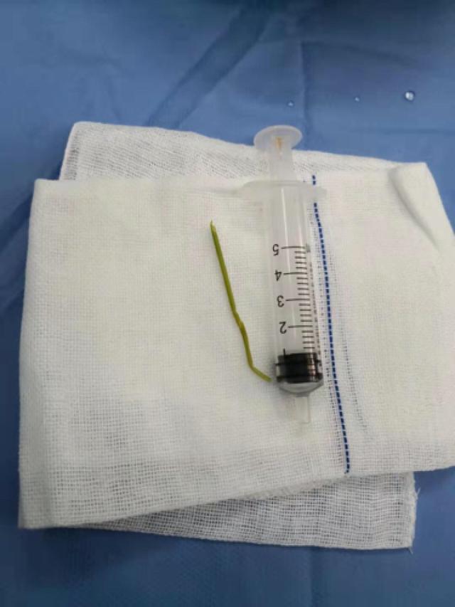 「生活报」11岁男孩突发性尿血 是膀胱内的草棍“作妖”