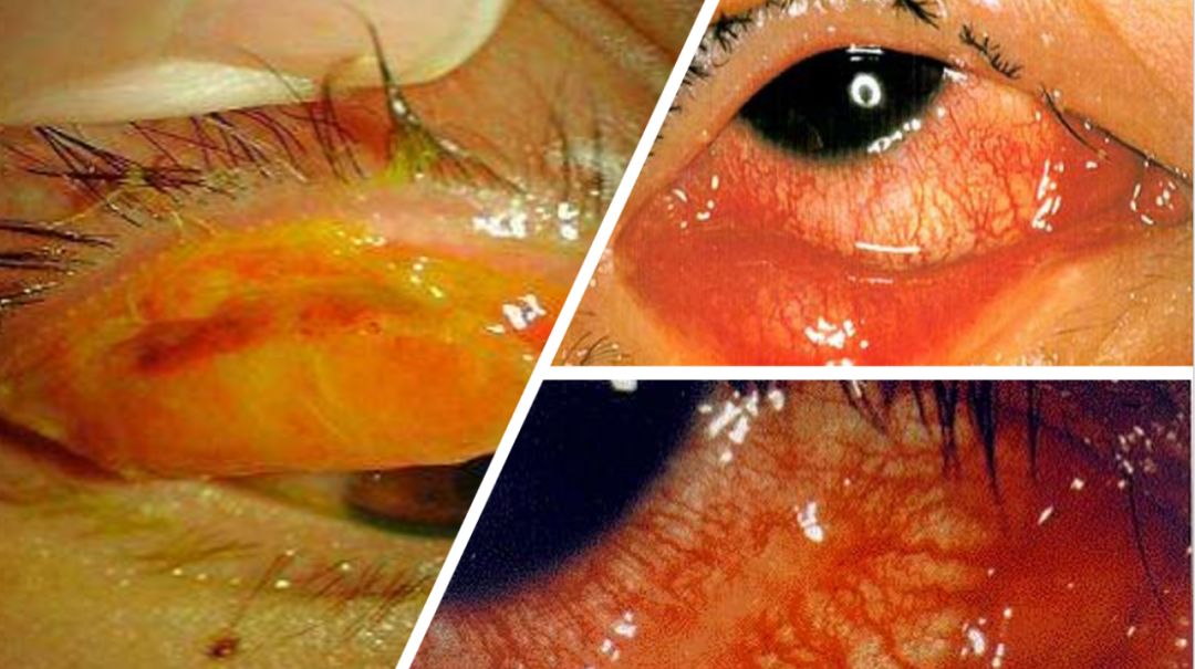 预防红眼病的流行?