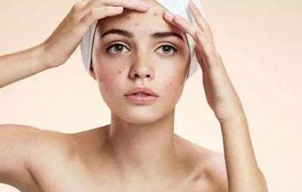 时尚大攻略：脸上痘痘反复难消，护肤方法要做对，记住三件事，痘痘不再有踪影