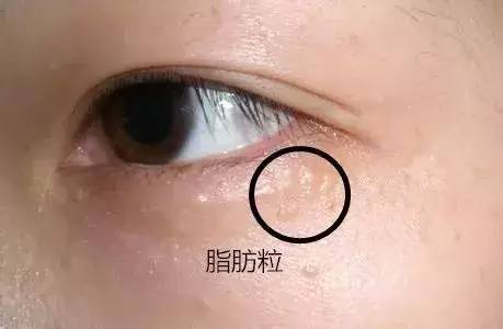 中国计划生育协会@黑眼圈、眼浮肿是因为熬夜？它还可能是疾病预兆！教你1招“看眼识病”