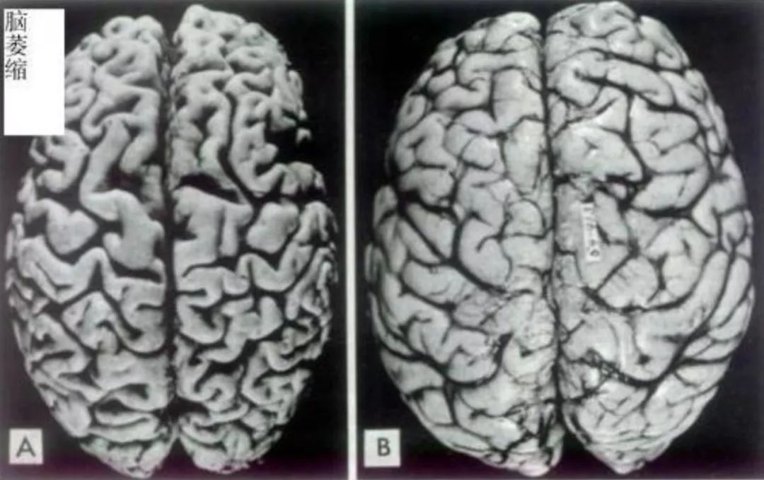 A.酒精性脑萎缩，B.正常脑