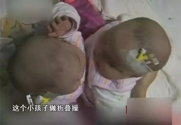 「半岛晨报」全国首例！坐骨连体女婴分离后双双成活了！10年后她们长成这样