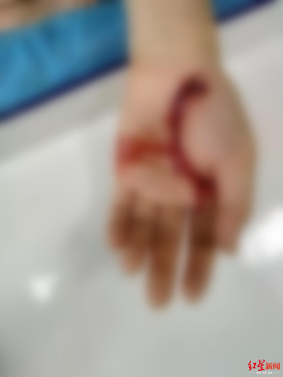 #红星新闻#被家暴致耳膜穿孔诉讼2年终离婚 女教师拿到1万精神抚慰金：我新生了