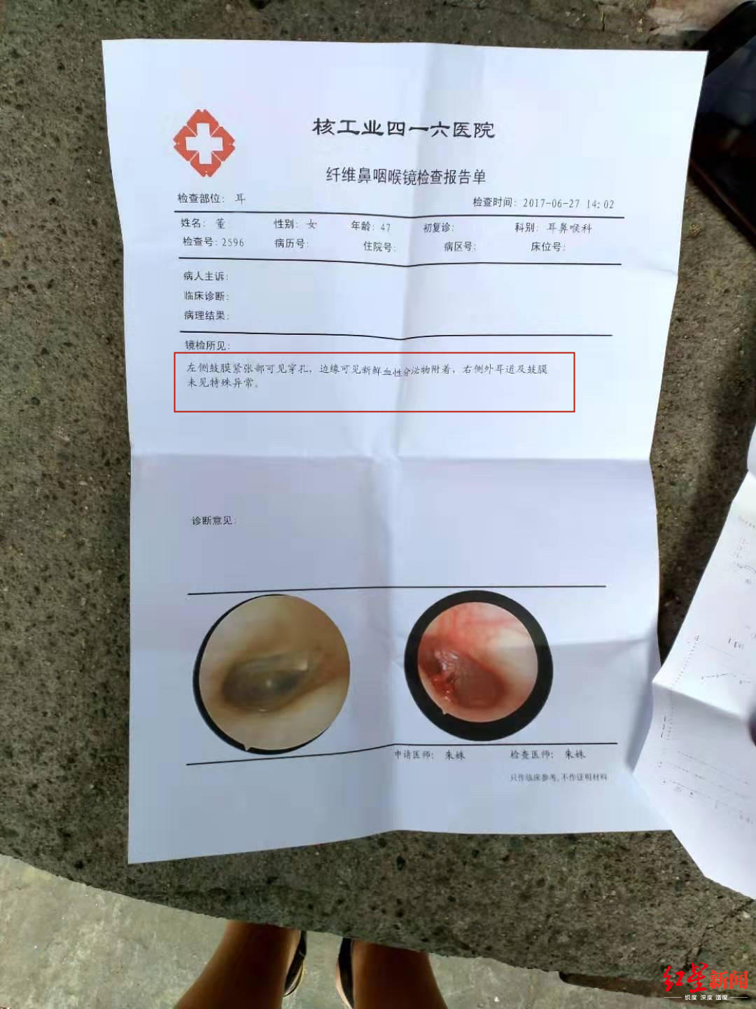 #红星新闻#被家暴致耳膜穿孔诉讼2年终离婚 女教师拿到1万精神抚慰金：我新生了