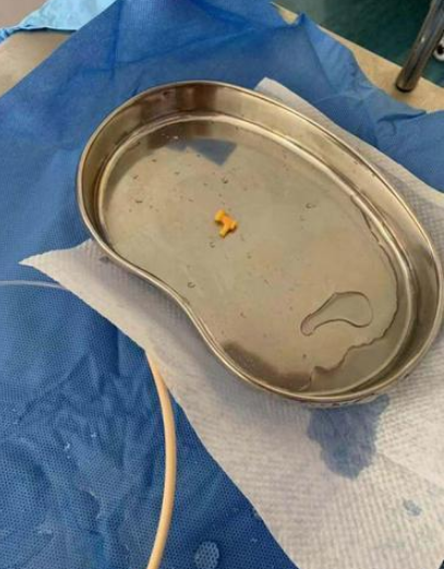 【海峡消费报】1岁女娃误食小玩具，宝妈却被送医急救，网友：这都是啥操作？