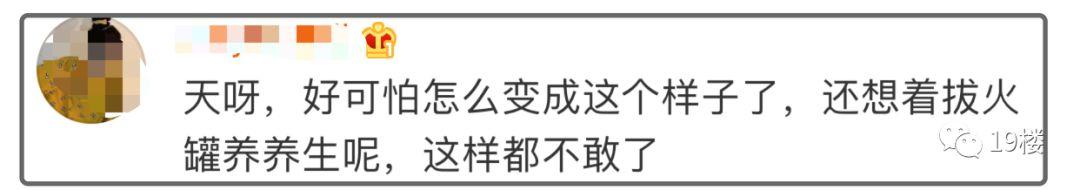 「生活报」女演员发文曝拔火罐被深二度烧伤，专家：注意事项要谨记