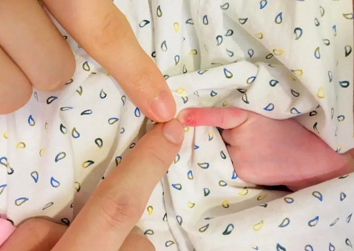 5个月婴儿紧握拳头奶奶发现不正常去医院检查后全家无法淡定