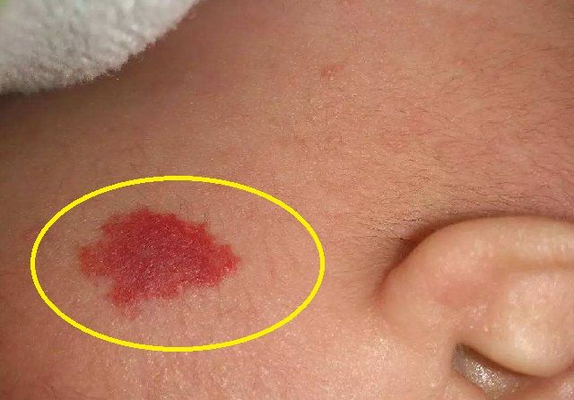 不想宝宝身上长胎记孕期这4件事忍住别做颜值会跟随他一辈子