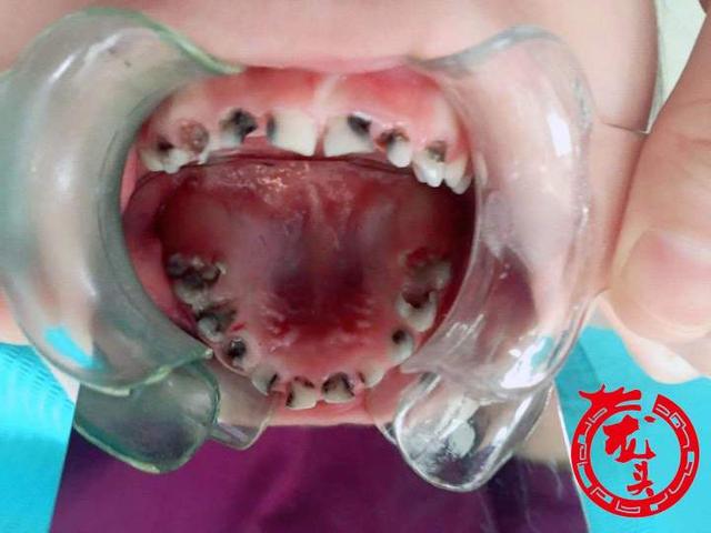 三岁娃牙疼得睡不着觉 一查18颗牙齿龋坏