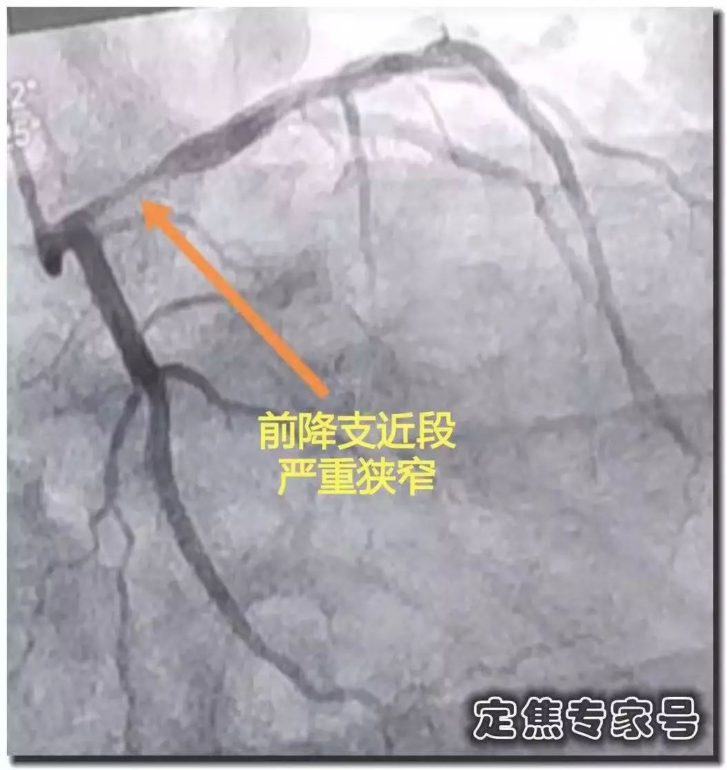 [人民日报]「提醒」从“上火”到心肌死亡仅5天！牢记16字，必要时能救命！