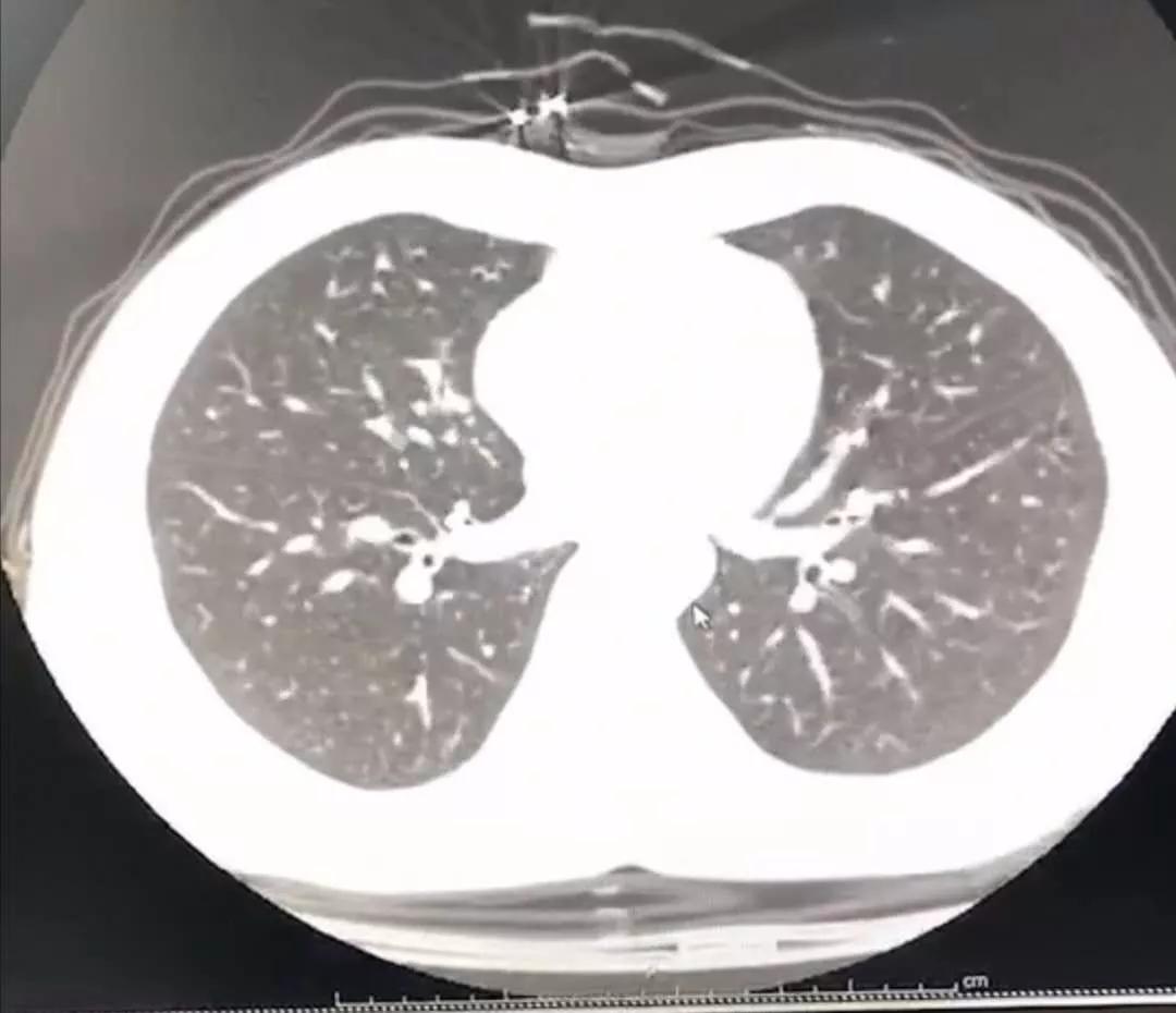 #经济日报#疑似感染新冠病毒，自我隔离四天好转，周宁医生怎么做到的