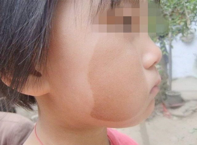 胎记是孩子前世的致命伤别无知了胎记形成的原因是这些