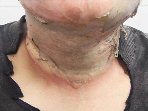 杭州小伙全身擦酒精消毒被烧伤!擦拭酒精,千万远离这些地方