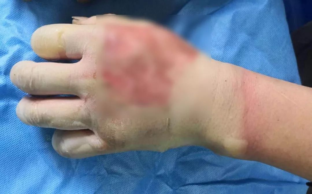 楚天都市报■男子全身擦酒精消毒，瞬间被火焰包围！
