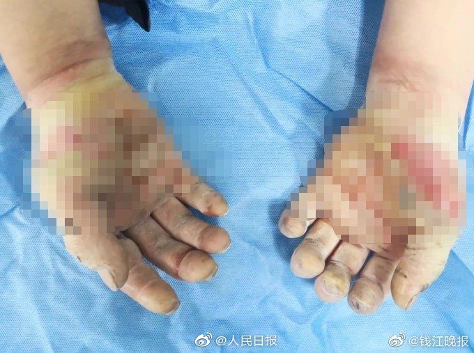 「半岛都市报」务必正确使用酒精！杭州一市民酒精消毒后烤电暖气全身着火