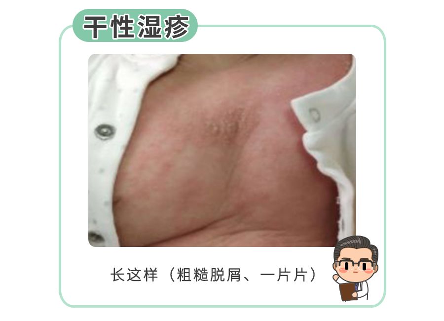 所有人只要答对这4道题可以搞定大多数小儿湿疹