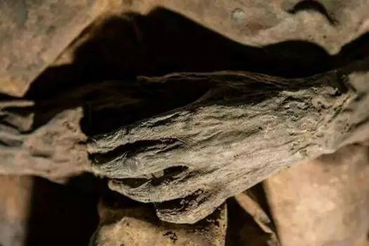 作为严重的传染病天花是如何被人类根除的