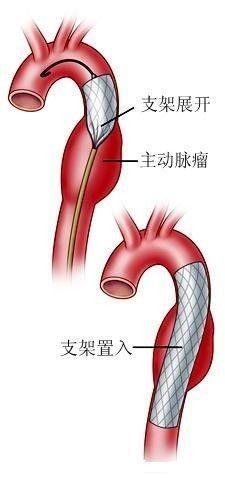 主动脉夹层支架植入术图片