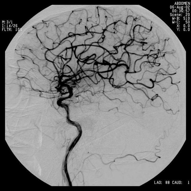 颈内动脉造影dsa清晰显示脑内血管