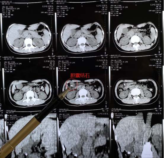 [怀孕]29岁女子怀孕中期曾前后5次住院，她看到检查后顿时傻眼了
