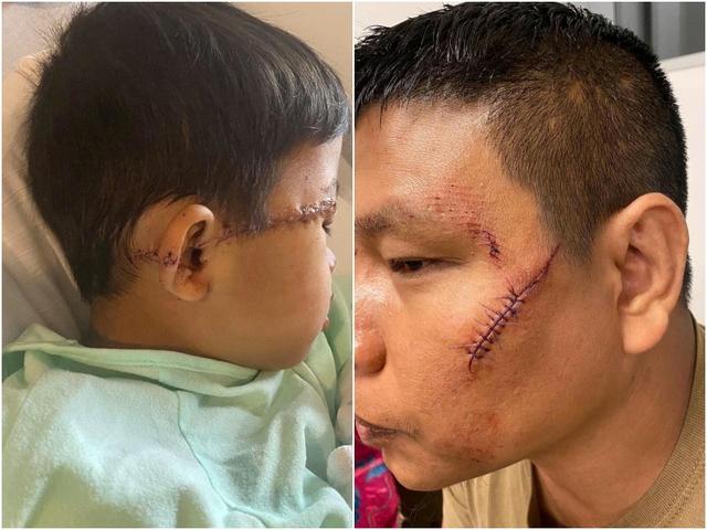 #国际社会#疑是因疫情针对亚裔暴力 美国泰裔一家四口遭袭毁容