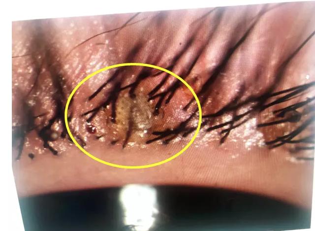 生活■活久见！2岁女孩睫毛密密麻麻长出这了这些，医生都惊呆了