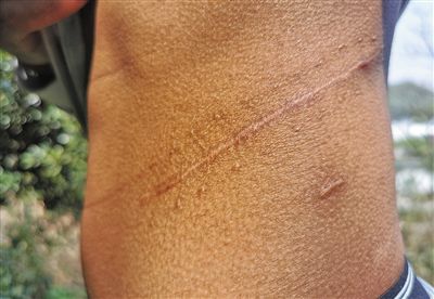 社会非法肾移植手术窝点：买肾人花55万 卖肾人只得4.5万