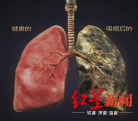 肺炎|世界无烟日 疾控专家提醒：吸烟者感染新冠肺炎更易发展为重症