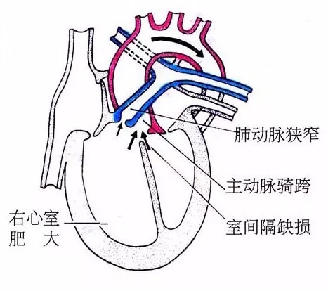 肺動脈狹窄2.右心室肥厚3.室間隔缺損4.