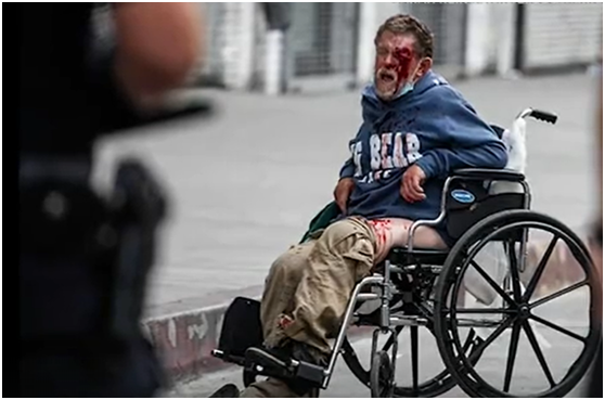 橡皮子弹|触目惊心!美国流浪汉遭警方橡皮子弹击中 满脸是血