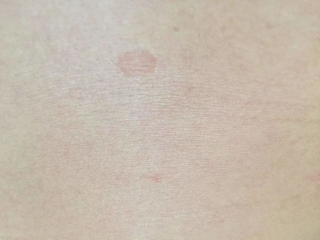 汗斑处皮肤可以恢复汗斑治愈后常会在皮肤上留下白色的斑疹,它是一种