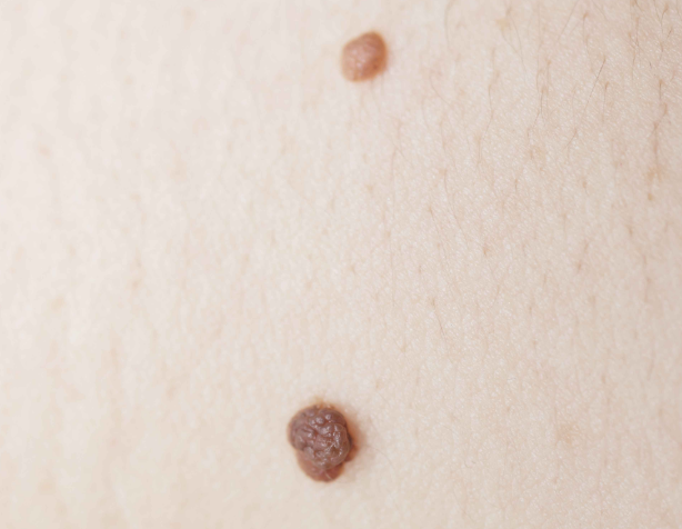痣隐藏癌变风险身上长这5种痣警惕是黑色素瘤别忽视