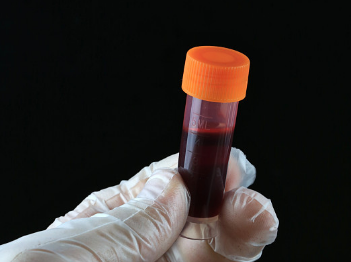 血型系统|最新研究！这种血型的人更易感染新冠病毒