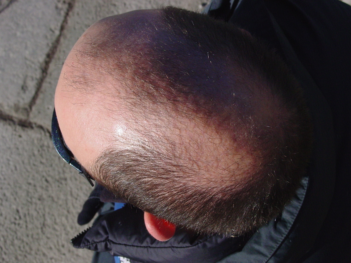 生活|为什么现在越来越多的年轻人脱发?