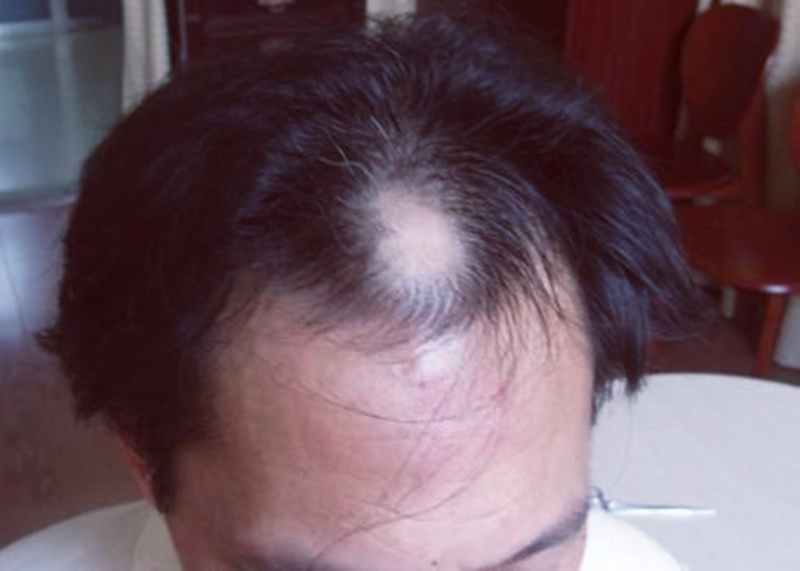 生活|为什么现在越来越多的年轻人脱发?